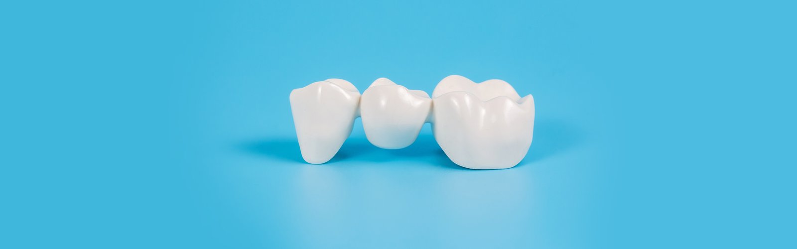 How Many Teeth Can You Put on a Dental Bridge?