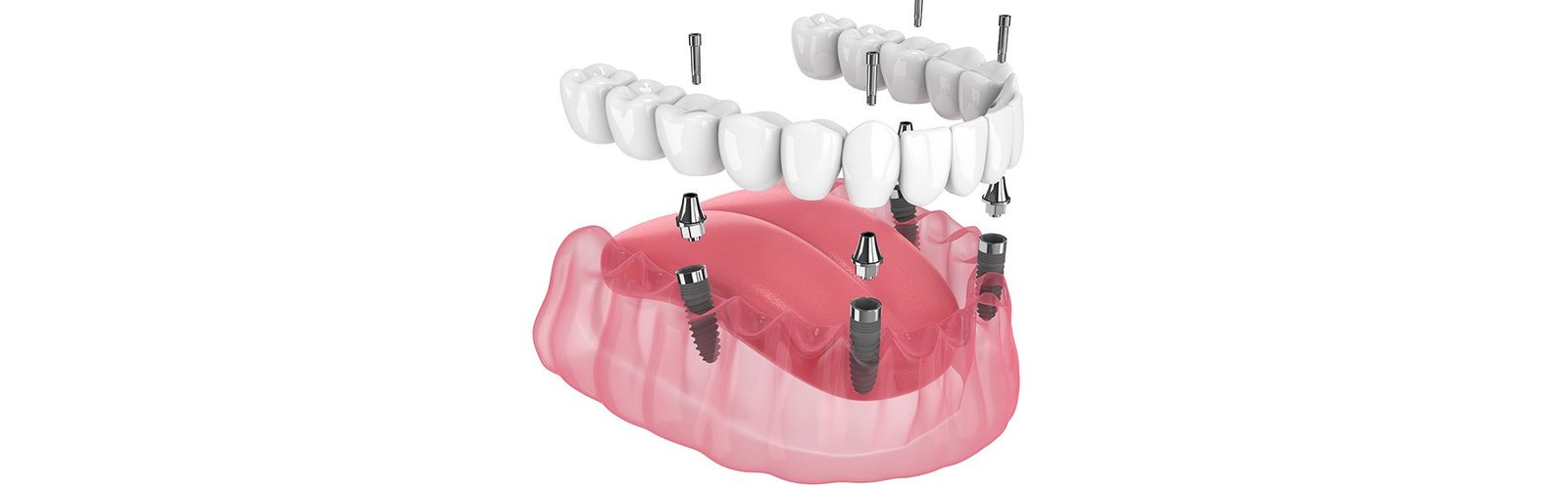 All-on-4® Dental Implants In El Dorado Hills, CA