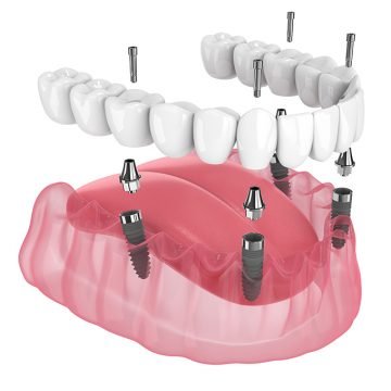 All-on-4® Dental Implants