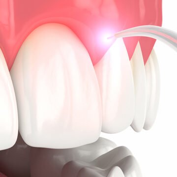 The Secret to a Flawless Smile: Inside the World of Dental Bonding