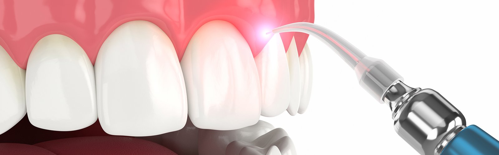 The Secret to a Flawless Smile: Inside the World of Dental Bonding