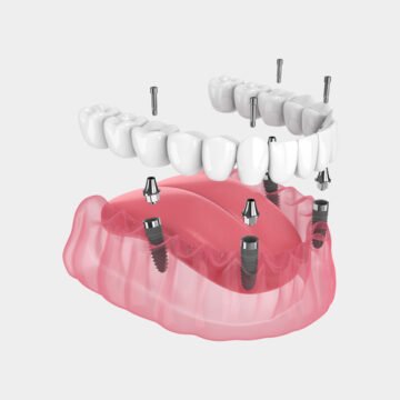 All-on-4 Dental Implants: Total Teeth and What You Should Know