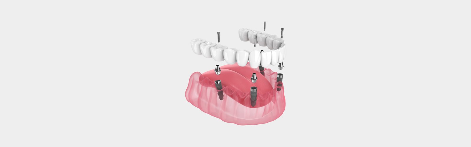 All-on-4 Dental Implants: Total Teeth and What You Should Know